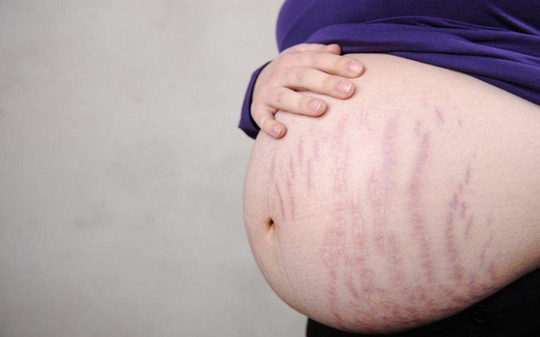 Rạn da thường xuất hiện khi mang bầu
