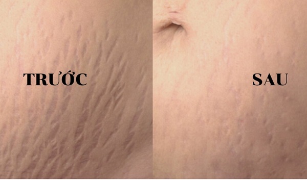 Hình ảnh trước và sau điều trị rạn da