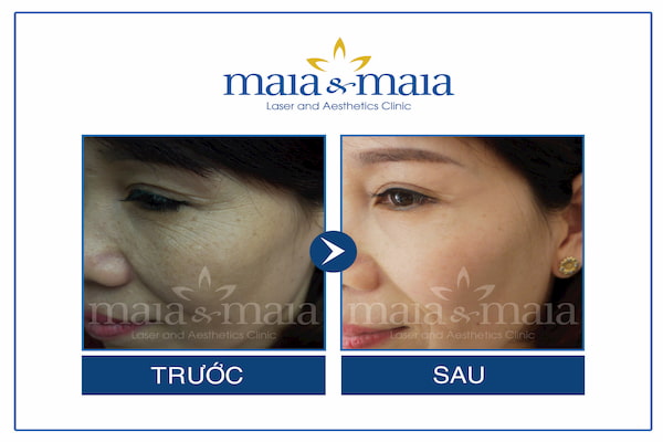 Hiệu quả khách hàng trước và sau liệu trình chăm sóc da chuyên sâu vùng mắt