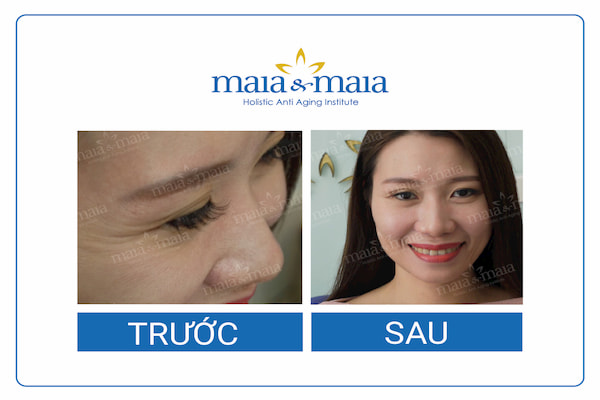 Hiệu quả khách hàng trước và sau liệu trình chăm sóc da chuyên sâu vùng mắt