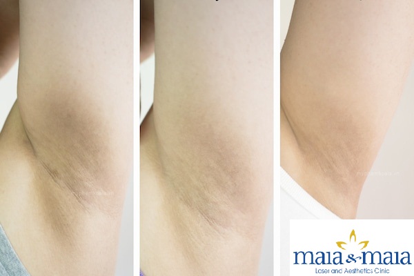 Hình ảnh : Trước và sau khi điều trị thâm nách tại PK Maia&Maia