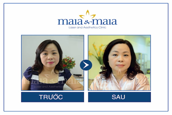 Khách hàng trước và sau khi trị liệu bổ sung collagen tại Mai&Maia