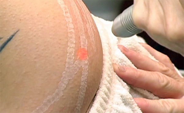 Một số công nghệ điều trị rạn da không hiệu quả