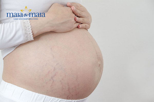 Rạn da thường xảy ra ở tháng thứ 4 thai kì hoặc ở cuối thai kì