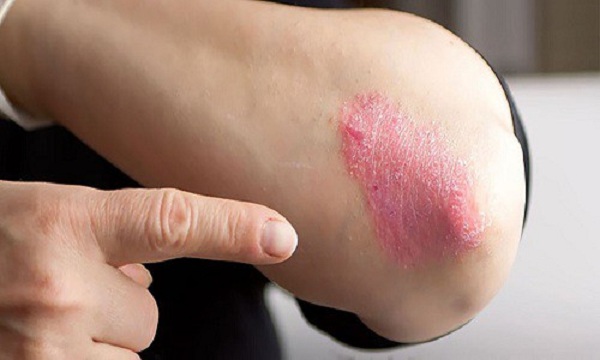 Hắc lào ở tay Hắc lào ở tay