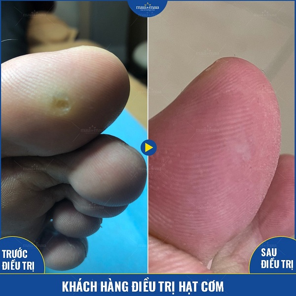 Hiệu quả hỗ trợ điều trị hạt cơm tại phòng khám Hiệu quả hỗ trợ điều trị hạt cơm tại phòng khám