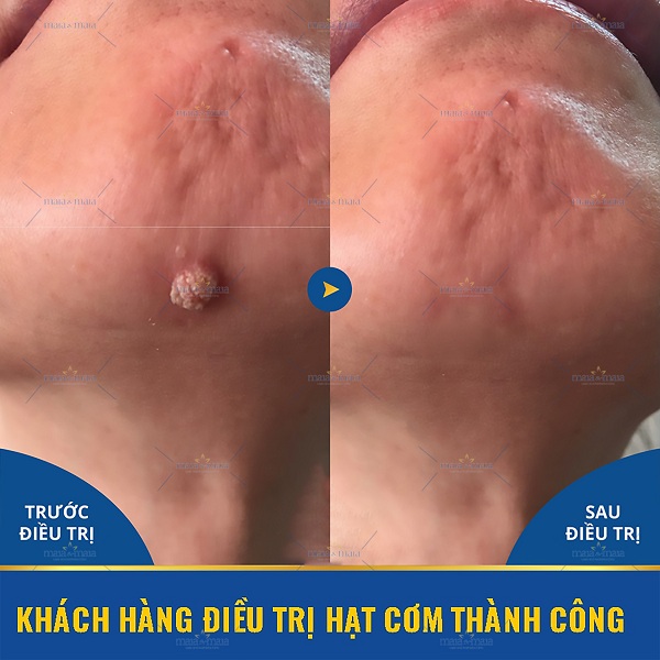 Hiệu quả hỗ trợ điều trị hạt cơm tại phòng khám Hiệu quả hỗ trợ điều trị hạt cơm tại phòng khám