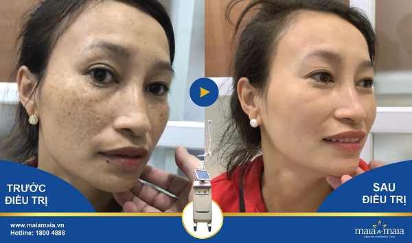 Kết quả điều trị nám trước - sau (ảnh thật 100%) Kết quả điều trị nám trước - sau (ảnh thật 100%)