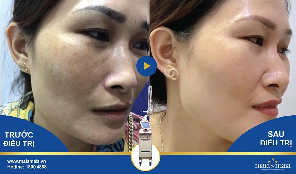 Kết quả điều trị nám trước - sau (ảnh thật 100%) Kết quả điều trị nám trước - sau (ảnh thật 100%)