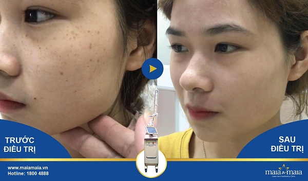 Kết quả điều trị nám trước - sau (ảnh thật 100%) Kết quả điều trị nám trước - sau (ảnh thật 100%)