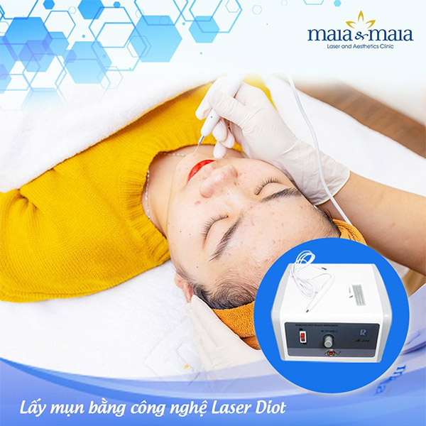 Xử lý nhân mụn công nghệ Laser Diot Xử lý nhân mụn công nghệ Laser Diot
