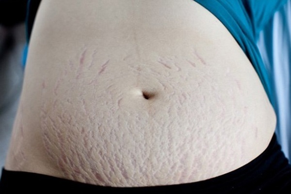 Nếu không điều trị, rạn da sẽ để lại những vết tích vô cùng mất thẩm mỹ