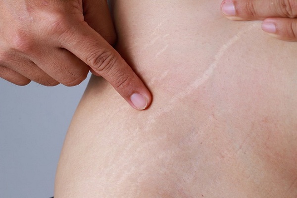 Mục tiêu của điều trị rạn da là mang lại vùng da đều màu hơn