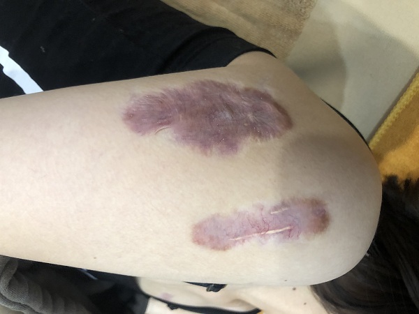 Sẹo thâm hình thành trên nền tổn thương sau tai nạn