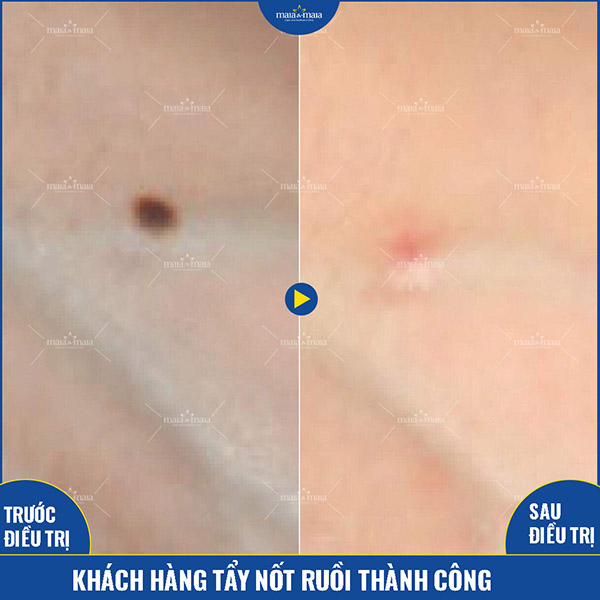 Kết quả hỗ trợ điều trị nốt ruồi của khách hàng Kết quả hỗ trợ điều trị nốt ruồi của khách hàng