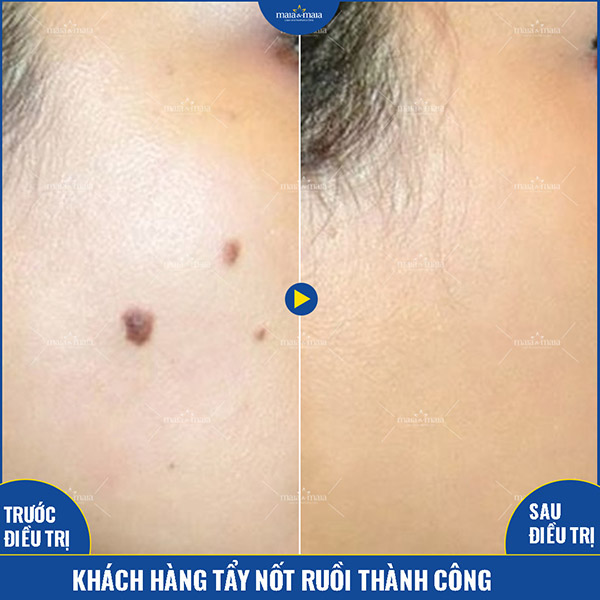 Kết quả hỗ trợ điều trị nốt ruồi của khách hàng Kết quả hỗ trợ điều trị nốt ruồi của khách hàng