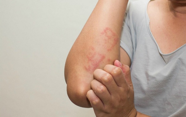 Gãi ngứa có thể gây tổn thương và để lại thâm sẹo