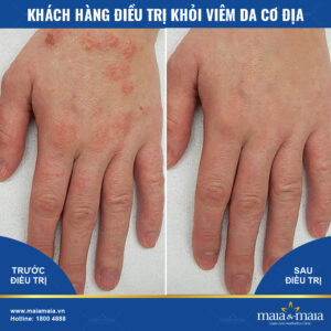 Kết quả hỗ trợ điều trị viêm da cơ địa Kết quả hỗ trợ điều trị viêm da cơ địa