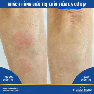 Kết quả hỗ trợ điều trị viêm da cơ địa Kết quả hỗ trợ điều trị viêm da cơ địa