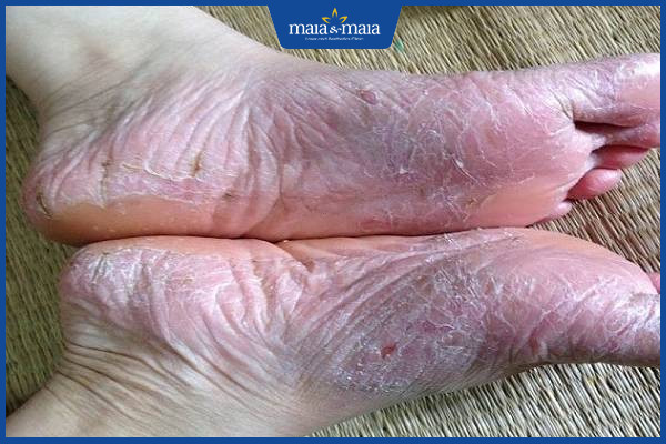 Da khô và bong tróc, tổn thương biểu hiện rõ