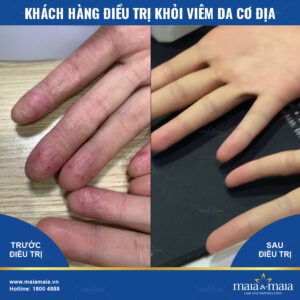 Kết quả hỗ trợ điều trị viêm da cơ địa Kết quả hỗ trợ điều trị viêm da cơ địa