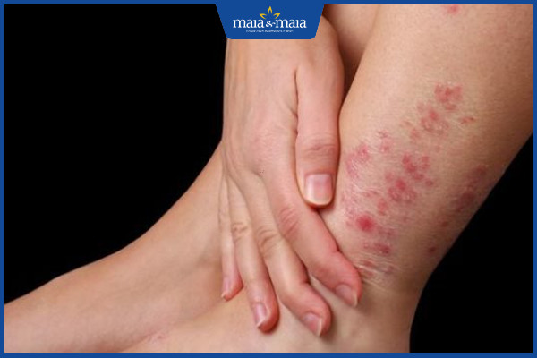 Viêm da cơ địa là bệnh lý viêm da mạn tính