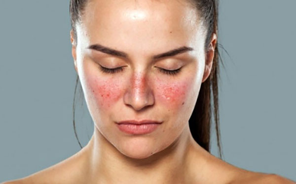 Hình ảnh: Người mắc bệnh Lupus ban đỏ