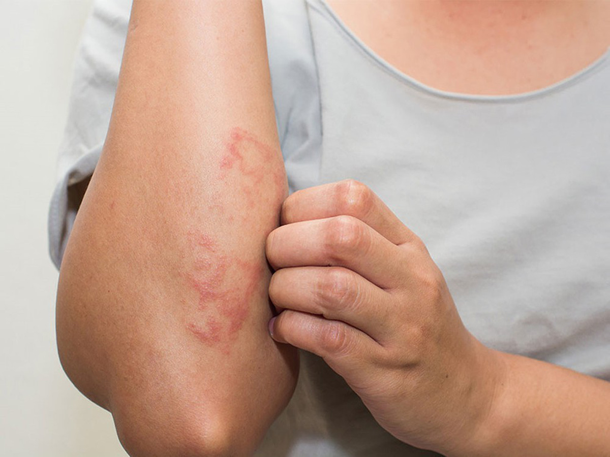 Bệnh chàm eczema biểu hiện trên da Bệnh chàm