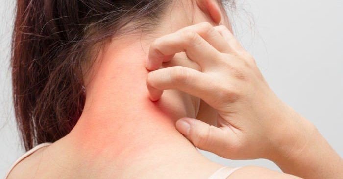 Ngứa da có thể là triệu chứng của ung thư hạch bạch huyết.