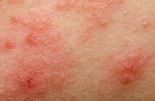 Da tổn thương do eczema tiến triển nặng Da tổn thương do eczema tiến triển nặng