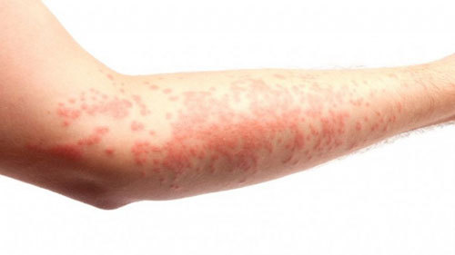 Eczema tiến triển nặng Eczema tiến triển nặng