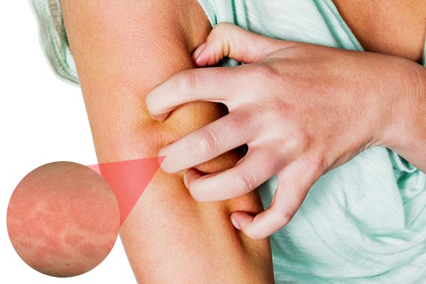 Hình ảnh: Ngứa da do nhiều nguyên nhân