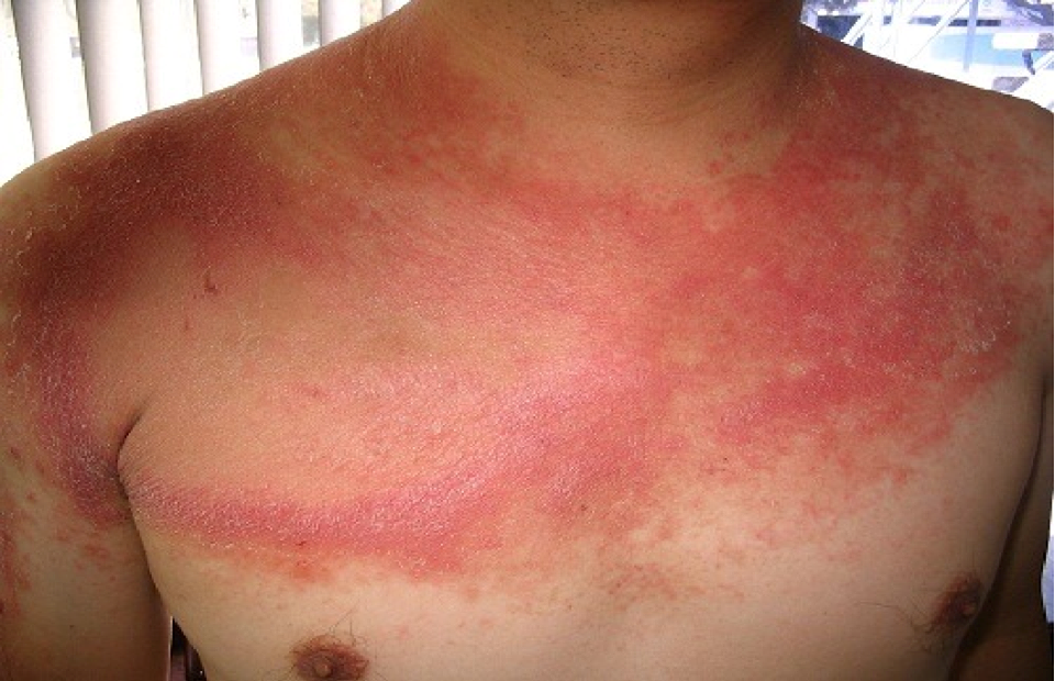 Hình ảnh: Lupus ban đỏ