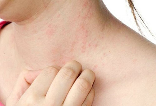 Hình ảnh: Ngứa da gây nhiều bất tiện trong cuộc sống