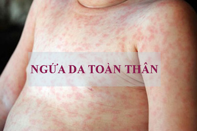 Hình ảnh: Ngứa toàn thân