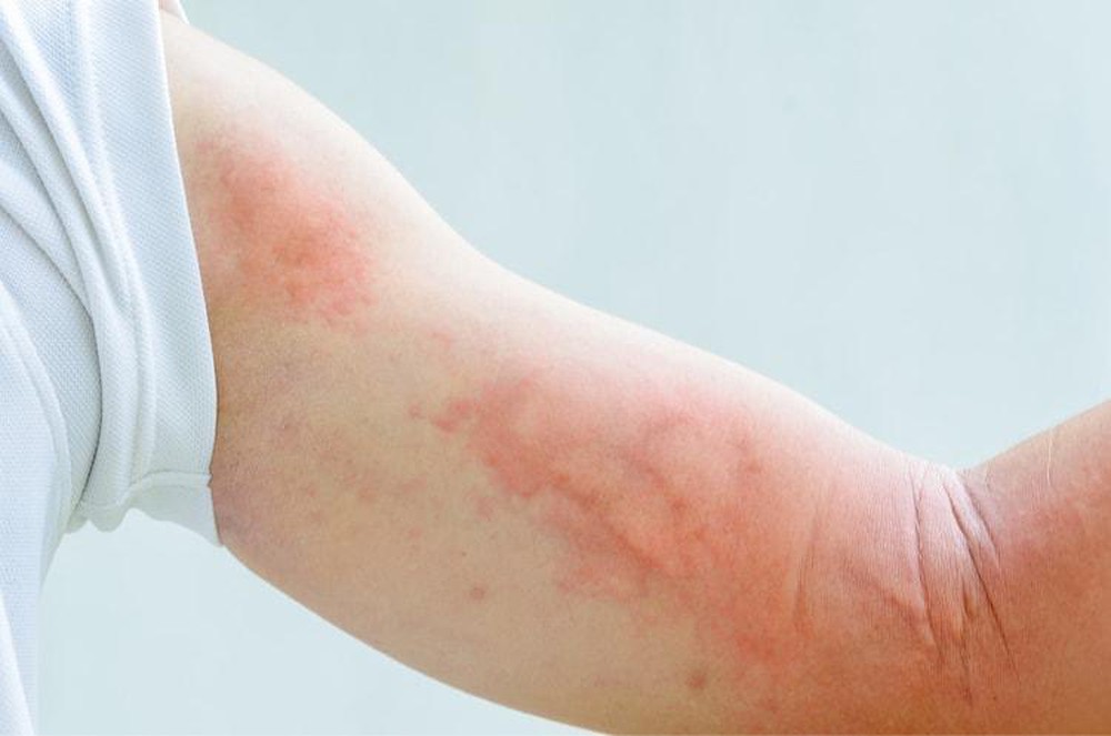 Hình ảnh: Bệnh nhân nổi mề đay khắp cánh tay