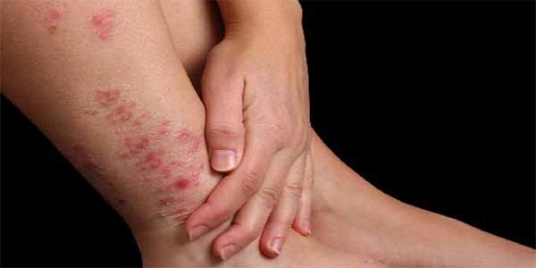 Hình ảnh: Viêm da tiếp xúc