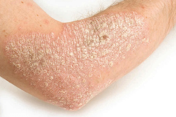 Hình ảnh: Bệnh vảy nến