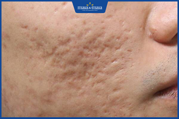 CÔNG NGHỆ MAITRIX FILL - ĐIỀU TRỊ TRIỆT ĐỂ BẤT CHẤP TUỔI SẸO LÕM!
