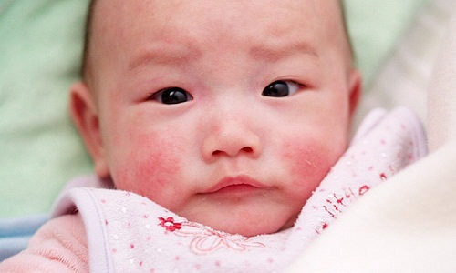 Hình ảnh: Lupus ban đỏ ở trẻ em