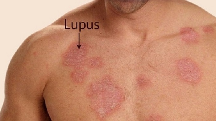 Hình ảnh bệnh lupus ban đỏ Hình ảnh bệnh lupus ban đỏ