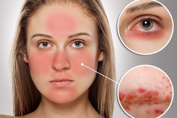 Hình ảnh: Lupus ban đỏ
