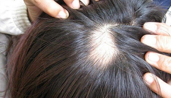 Hình ảnh: Rụng tóc gây mất thẩm mỹ