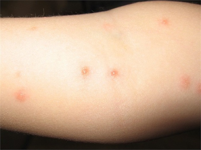 Nguyên nhân gây bệnh thủy đậu là do virus Nguyên nhân gây bệnh thủy đậu là do virus