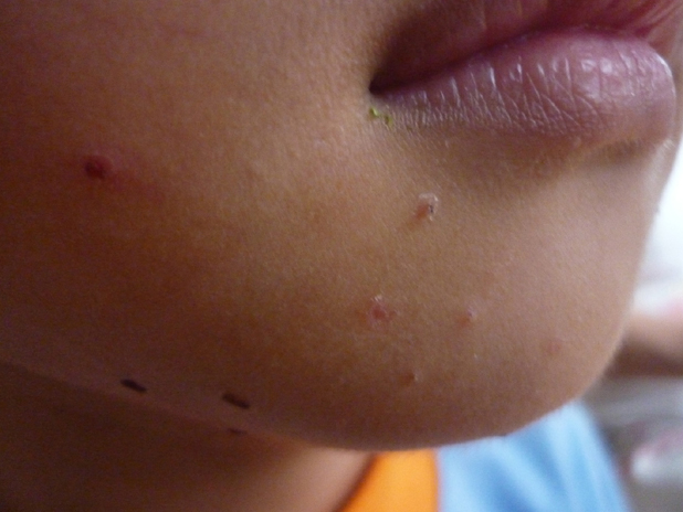 HÌnh ảnh: Bệnh u mềm lây ở mặt