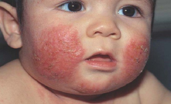 Viêm da tiết bã Viêm da tiết bã