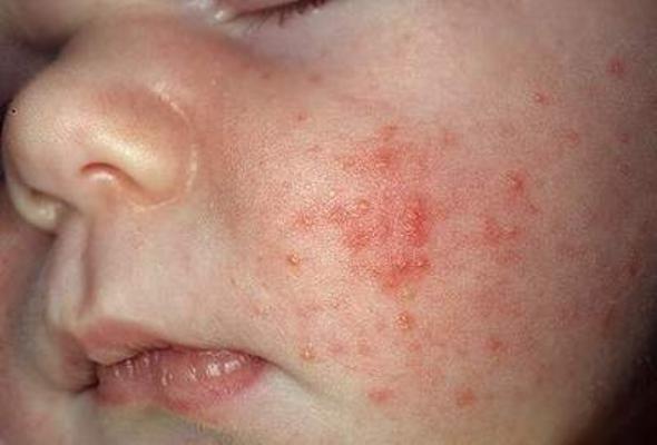 Hình ảnh: Bệnh viêm da mủ