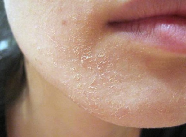 Viêm da tiết bã Viêm da tiết bã