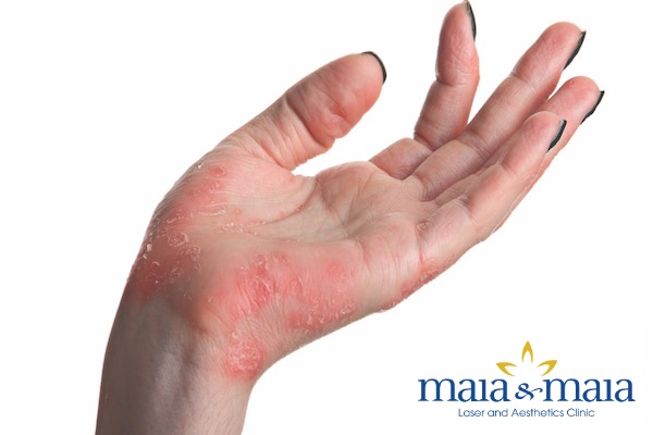 Bệnh vảy nến ở tay- Phòng khám chuyên khoa da liễu Maia Bệnh vảy nến ở tay