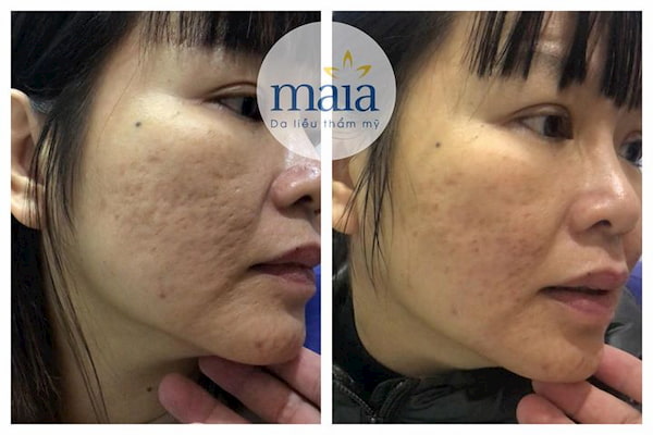 Hình ảnh : Trước và sau khi điều trị sẹo lõm bằng công nghệ Laser Mixel Hình ảnh trước sau